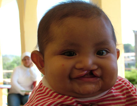 cleft lip before and after. of cleft-lip-baby