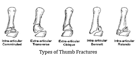 Fracture Types