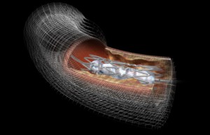 Heart Stent History