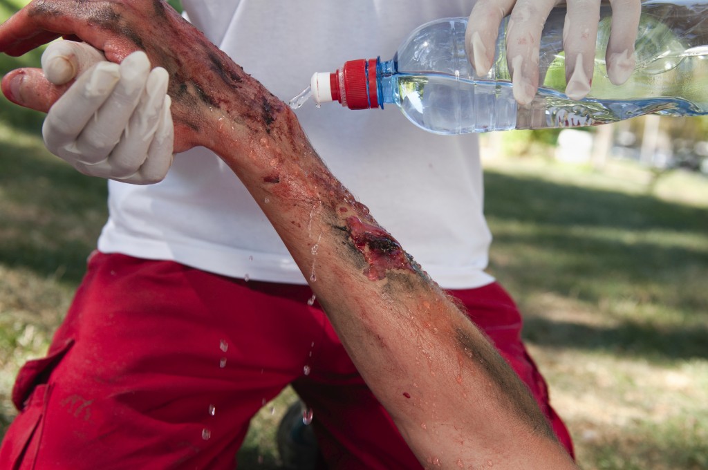 cleaning a burn injury victims arm