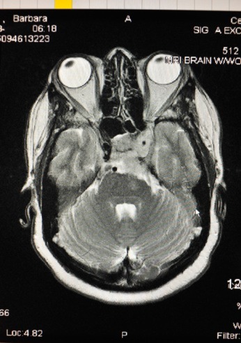 traumatic brain injury