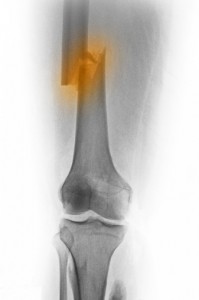 Types of Femur Fractures