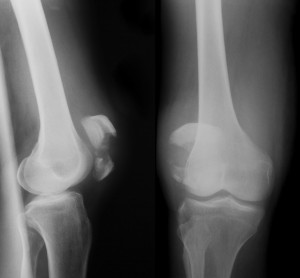 Broken Leg | Fractured Proximal Tibia | Orthopedic Attorney