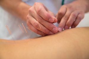 Treatment by acupuncture